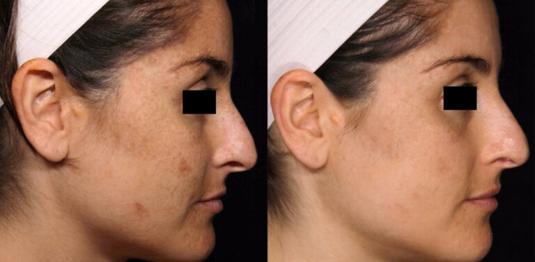 thumbnail_O PicoSure é o primeiro laser do mundo específico para tratamento de melasma olheira cicatrizes de acne e para a remoção de tatuagens de maneira profunda e eficaz