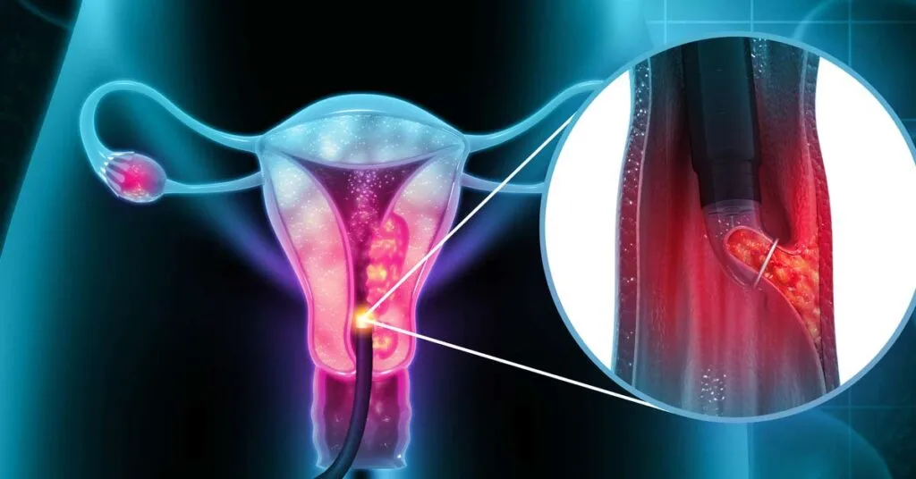 SUS Adota Teste DNA-HPV para Rastreamento do Câncer de Colo do Útero